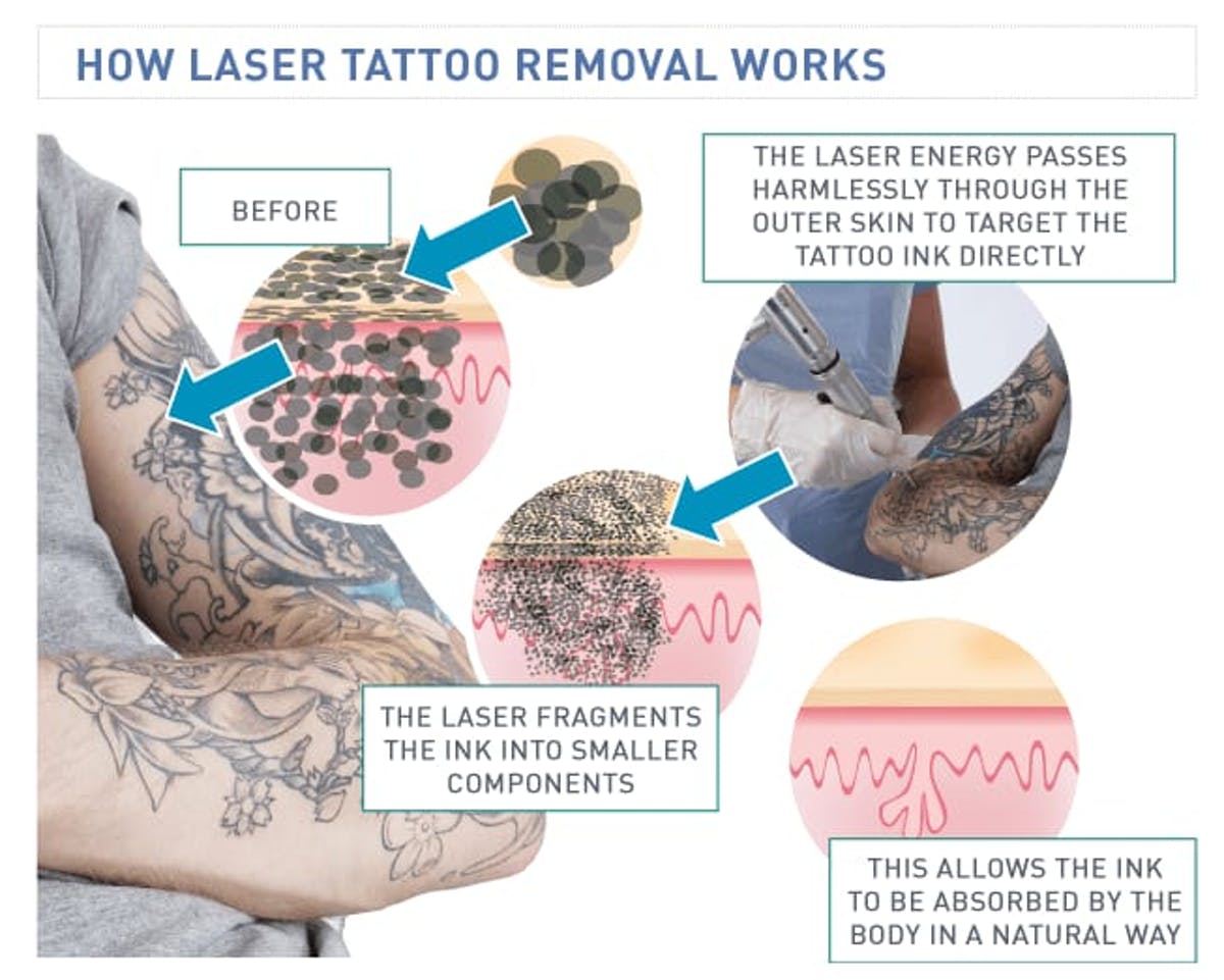 tattoo removal laser